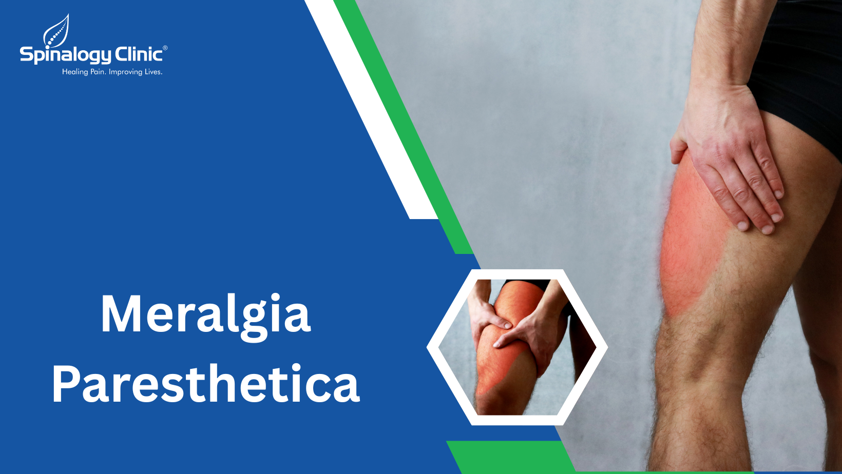 Meralgia Paresthetica: The Strange Thigh Burning Sensation Explained